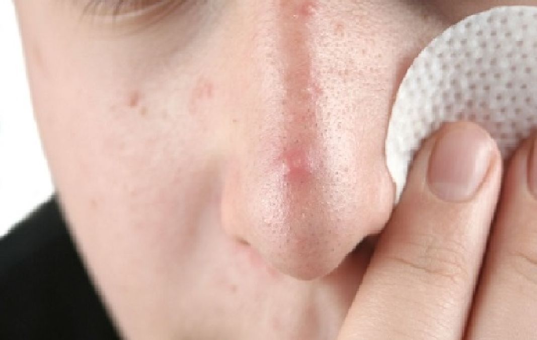 Comment se débarrasser de l’acné grâce à une bonne alimentation ?
